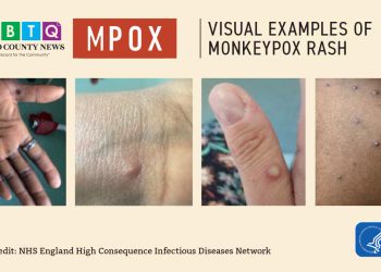 San Diego County Reports Increase in Mpox Cases