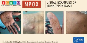 San Diego County Reports Increase in Mpox Cases